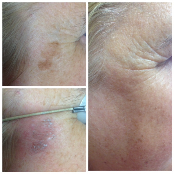 laser treatment for age spots at Canterbury skin and laser clinic kent Photo